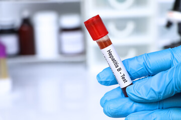 Hepatitis B test to look for abnormalities from blood