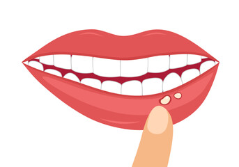 Mouth ulcer concept vector illustration on white background. - obrazy, fototapety, plakaty