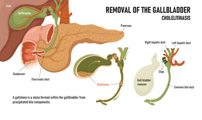Cholecystitis. Inflammation of the gallbladder and bile ducts. Gallstones. Removal of the gallbladder