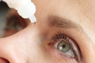 Caucasian woman using medical drops and dripping eye close up.