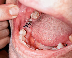 Close-up of a gum after surgery. Post operative tooth extraction with stitches. Concept of dental implant and preparation for surgery.