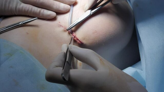 Professional surgeons suture breast during surgery. Breast augmentation plastic surgery.