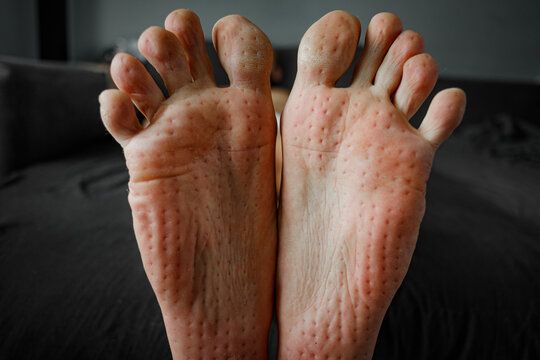 After Standing On Acupuncture Needle Yoga Mat