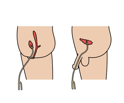 膀胱留置カテーテル の画像 4 件の Stock 写真 ベクターおよびビデオ Adobe Stock 膀胱留置カテーテル の画像 4 件の Stock 写真 ベクターおよびビデオ Adobe Stock