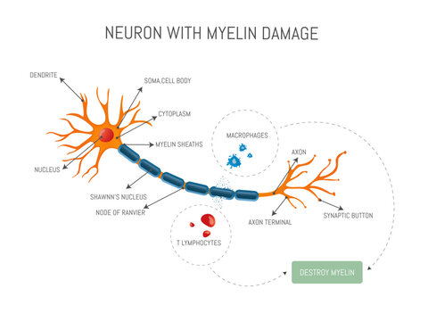 Infographic of a neuron damaged by lymphocyte and macrophage attack that destroys myelin in multiple sclerosis disease.