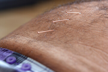 Acupuncture needles in body