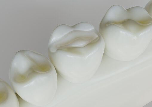 Ceramic Inlay crown in a tooth- 3D Rendering
