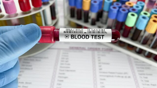 Doctor holding Blood sample tube for analysis of blood chemist study in the laboratory. Technician lab with Blood testing over requisition report for analysis chemistry
