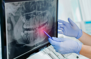 Hands doctor dentist in gloves show the teeth on x-ray on digital screen in dental clinic on light...