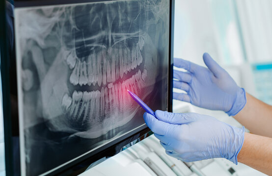 Hands doctor dentist in gloves show the teeth on x-ray on digital screen in dental clinic on light background with medical equipment. Smile healthy teeth concept, close up