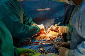 Open heart surgery due to malfunction of the heart valve, valve replacement is performed in the...