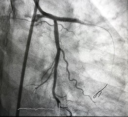 coronary angiogram shown massive thrombus that occluded left anterior descending artery (LAD) in...