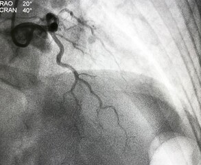 coronary angiogram shown massive thrombus that occluded left anterior descending artery (LAD) in patient with ST elevation myocardial infarction (STEMI).