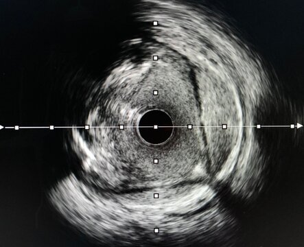 Intravascular ultrasound imaging (IVUS) shown hematoma in coronary artery.