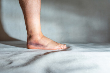 Sprained and swollen ankle.Mans sprained ankle at home.Ankle sprain.Injury.White,gray background,copy space. - obrazy, fototapety, plakaty