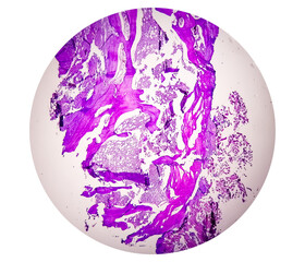 Microscopic examination of thyroglossal duct cyst. Persistent thyroglossal duct.