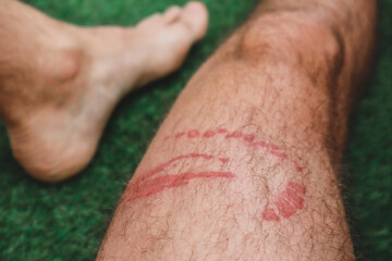 A jellyfish sting burn on a man's leg © Andrei Antipov