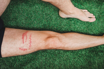 A jellyfish sting burn on a man's leg © Andrei Antipov