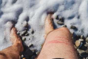 A jellyfish sting burn on a man's leg