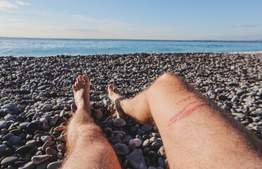 A jellyfish sting burn on a man's leg
