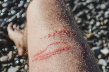 A jellyfish sting burn on a man's leg © Andrei Antipov