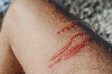 A jellyfish sting burn on a man's leg © Andrei Antipov