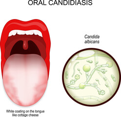 oral candidiasis. oral thrush yeast infection. - obrazy, fototapety, plakaty