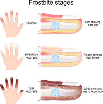 Frostbite Stages Of Fingers