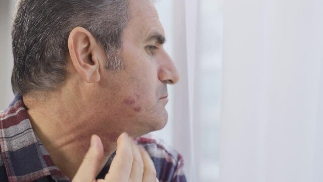 The man with the rose stain on his face. Facial irritation.
The man looking in the mirror at the rose stains on his face.

