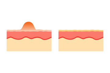 vector illustration of an anatomy comparison of healthy and acne-prone skin. epidermis and desmis of the skin. illustration for skin medical science and health.