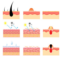 vector illustration of human skin structure anatomy. various skin conditions. epidermis and desmis. illustration for science and medical health. - obrazy, fototapety, plakaty
