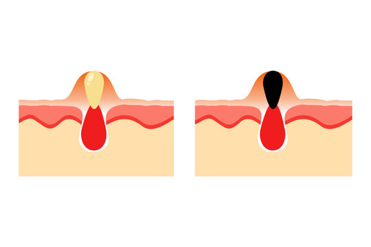 vector illustration of acne skin anatomy comparison, blackhead and whitehead. epidermis and desmis of the skin. illustration for skin medical science and health.