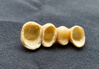 Provisional dental bridge isolated on grey background. Temporary resin teeth. Dental health and implant concept