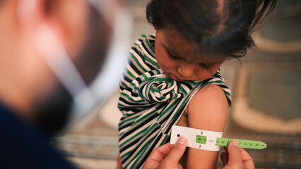 Malnutrition was measured using a mid-upper arm circumference belt