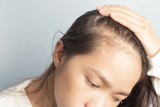 Young women stressed and having hair loss, thinning hair.