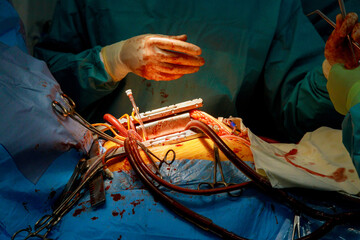 As part of heart operations due to coronary heart disease that are being performed in operating...