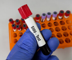 Blood sample for S-100 protein test, for disease monitoring in metastatic melanoma.Dermatology.