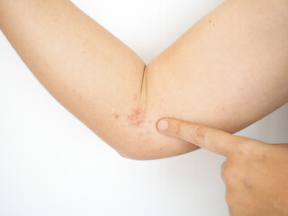 Herpes zoster or shingles symptoms on arm woman.