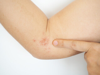Herpes zoster or shingles symptoms on arm woman.