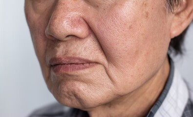 Enlarged pores in face of Asian, elder man with skin folds.