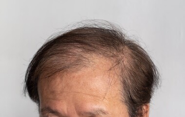 Bald head of Asian man. Concept of male pattern hair loss or sparse hair. - obrazy, fototapety, plakaty