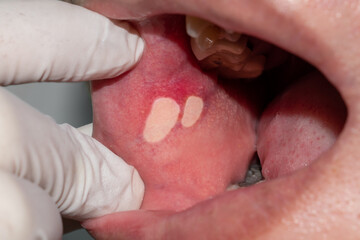 Aphthous ulcer or stress ulcer in mouth of Asian patient.