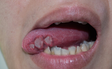 Ulcers at the tongue of Asian patient. Diagnosis may be aphthous ulcer, canker sore, stress ulcer or tongue cancer.