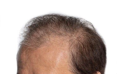Bald head of Asian man. Concept of male pattern hair loss or sparse hair.