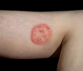 Fungal infection called tinea corporis