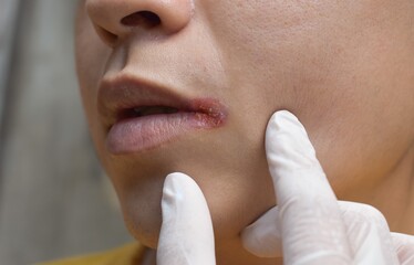 Angular stomatitis or angular cheilitis or perleche in asian man. Mouth ulcer. Common inflammatory...