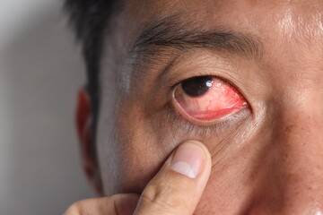 Corneal infection or ulcer called keratitis in Asian Chinese man.