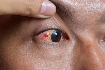 Ocular larva migrans or dilated vessels in the eye of Asian man.