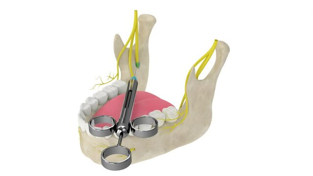 Mandibular arch with inferior alveolar nerve block. Types of dental anesthesia concept. 