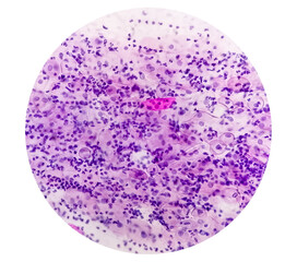 Paps smear. Microscopic examination of pap smear showing inflammatory smear with early atrophic changes. NILM. cervical cancer diagnosis.